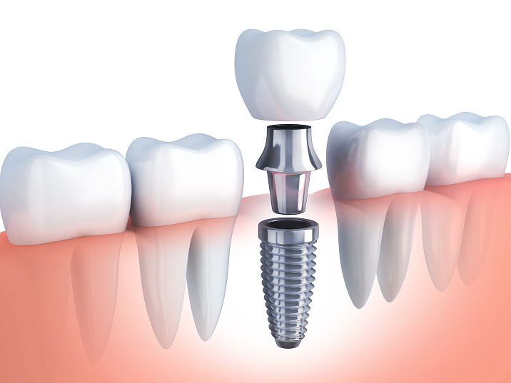 Dental Implants