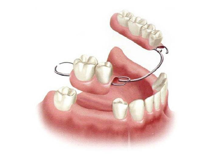 Dental Implants
